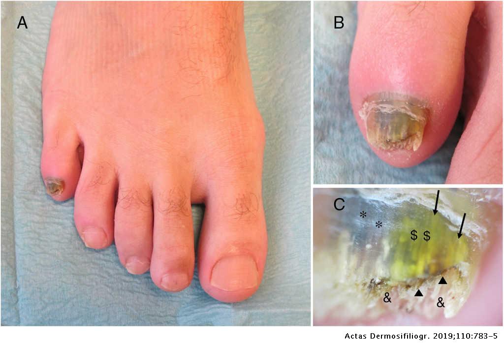 Green Nail Caused by Onychomycosis Coinfected With Pseudomonas aeruginosa |  Actas Dermo-Sifiliográficas