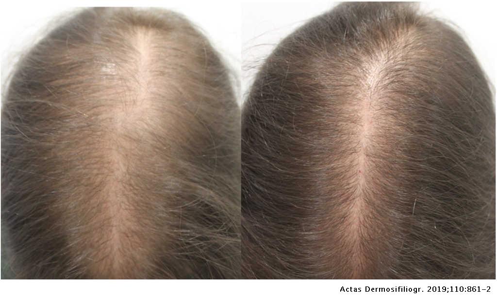 RF – Oral Minoxidil for Female Pattern Hair Loss and Other Alopecias |  Actas Dermo-Sifiliográficas