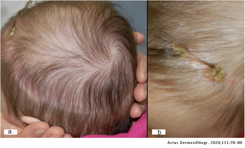 Annular Hair Loss and Persistent Crusting in a Baby | Actas  Dermo-Sifiliográficas