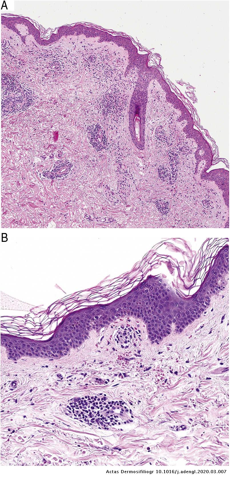 Pigmented Purpuric Dermatosis: A Review of the Literature | Actas Dermo ...