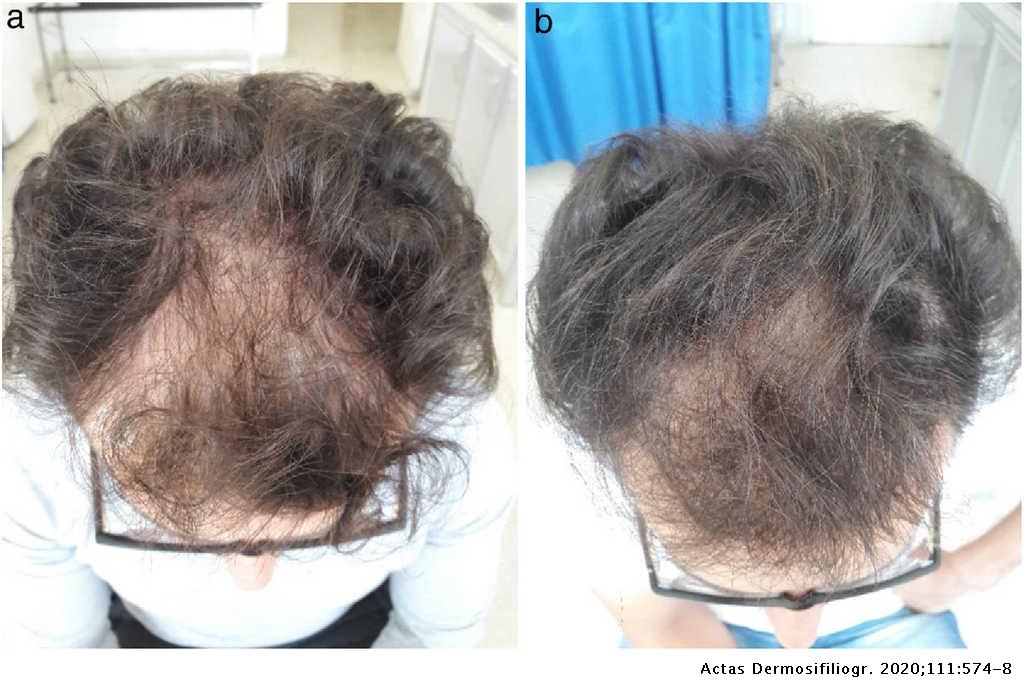 Efficacy of platelet rich plasma intradermal injections for androgenetic  alopecia treatment in males: A Before and after study | Actas  Dermo-Sifiliográficas
