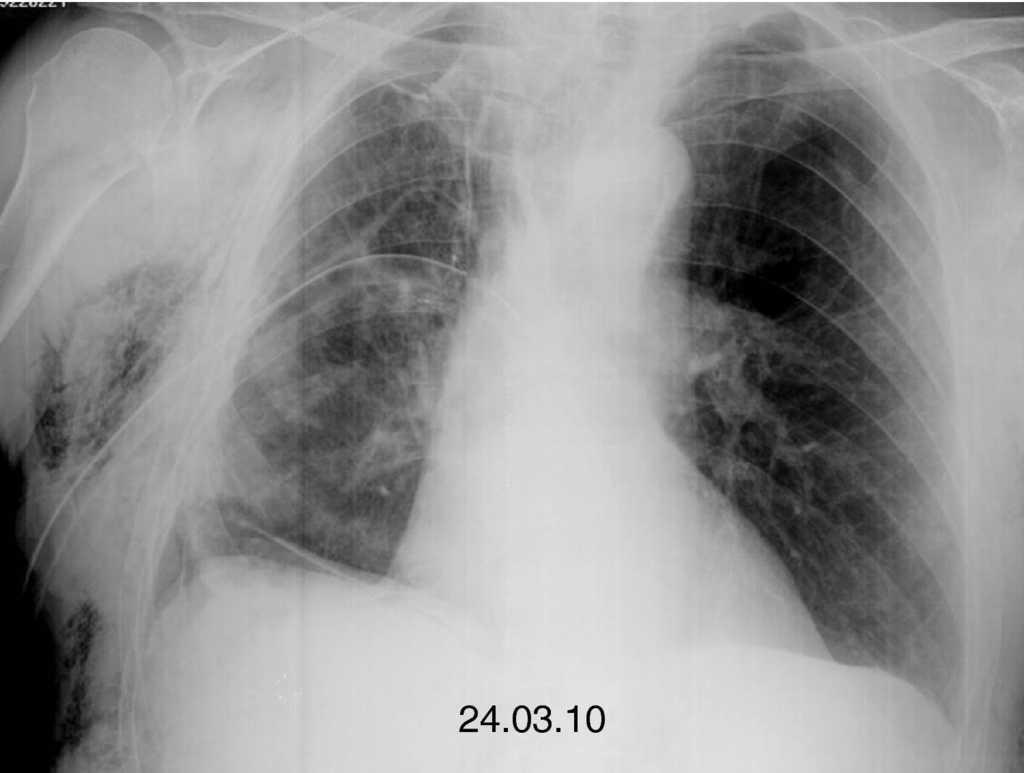 Endoscopic Treatment of Persistent AlveolarPleural Air Leaks With a