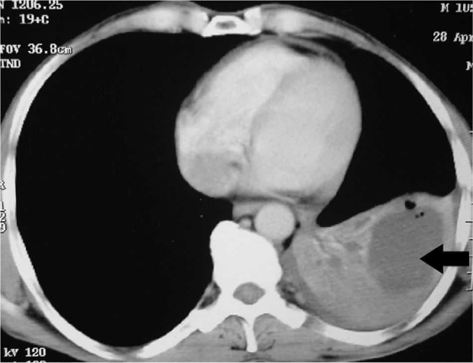 Lung Cyst Caused by Centrally Located Bronchogenic Carcinoma | Archivos ...