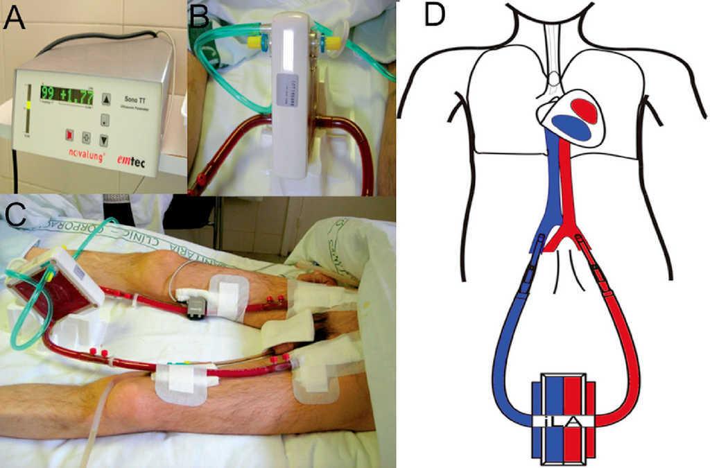 Extracorporeal Lung Assist in Severe Respiratory Failure and ARDS ...