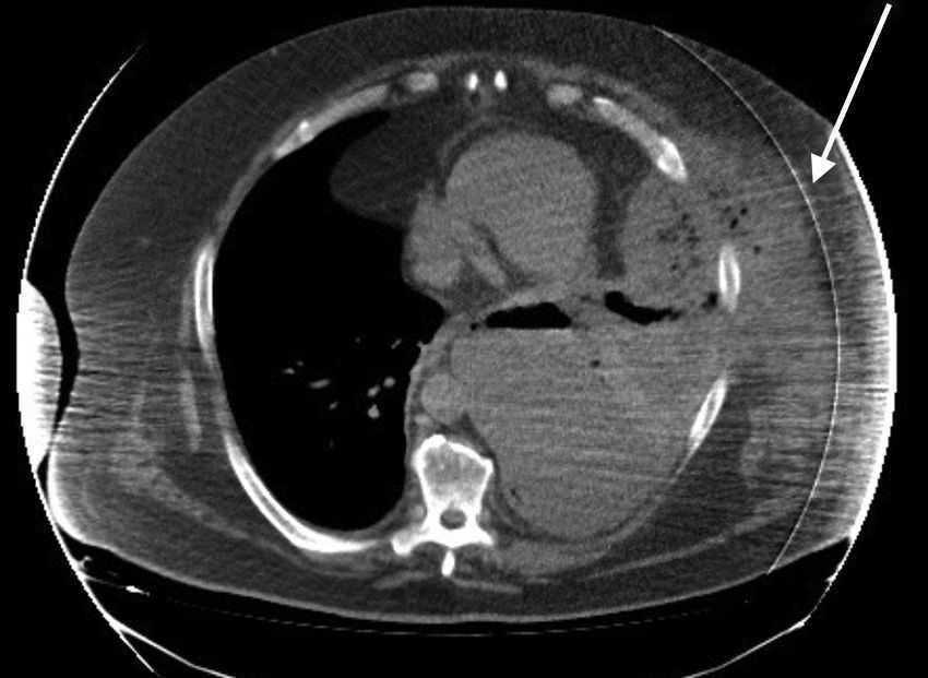 Empyema Necessitatis Following Chest Trauma 