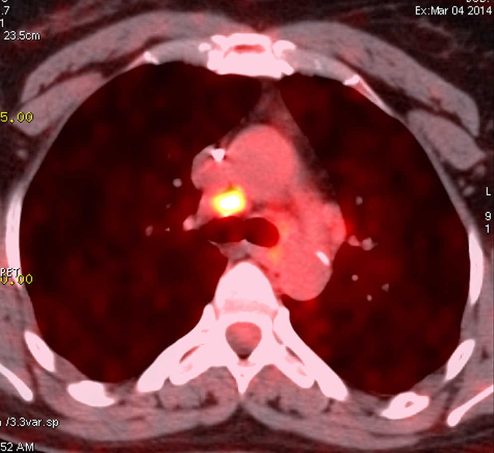 Mediastinal Sarcoidosis Mimicking Lymph Malignancy Recurrence After 4210