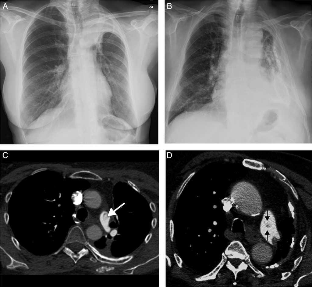 False Pulmonary Embolism on Computed Tomography Angiography in Two ...