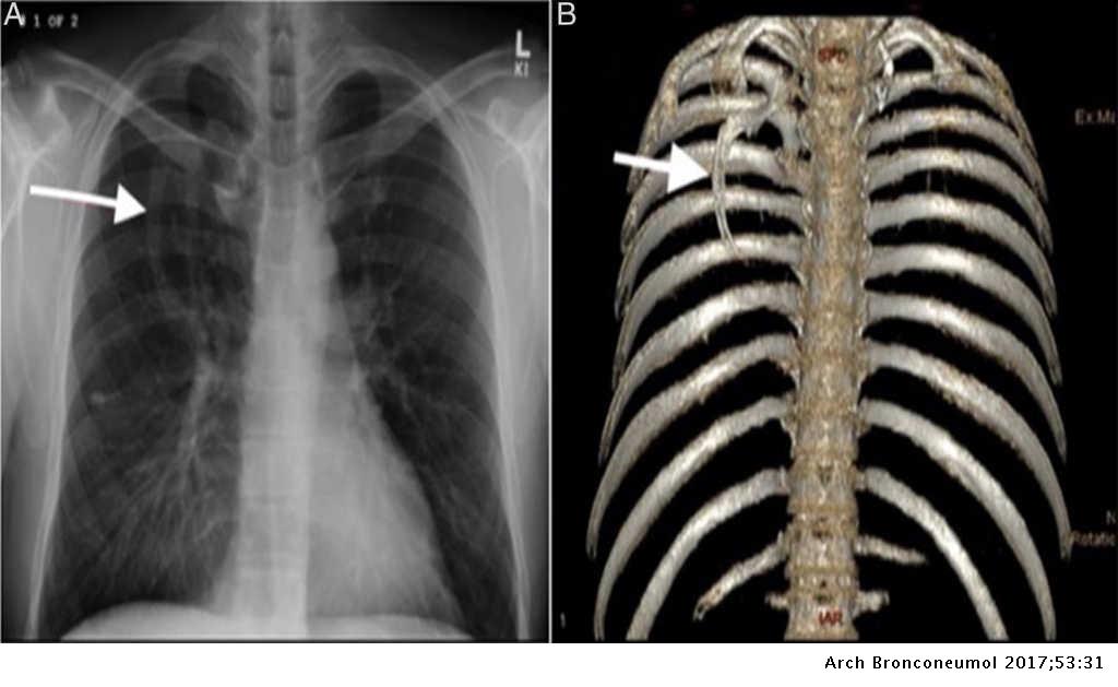 Radiografia De Costillas