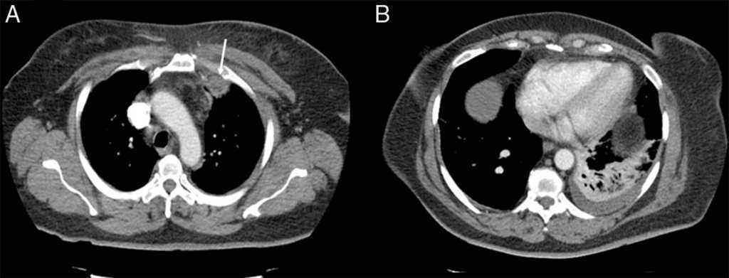 S. aureus Pneumonia and Sternoclavicular Septic Arthritis: An Unusual ...