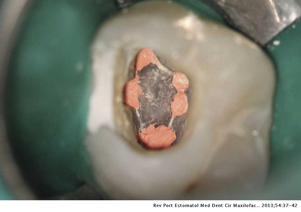 Endodontic Treatment Of The Maxillary First Molar With Five Root