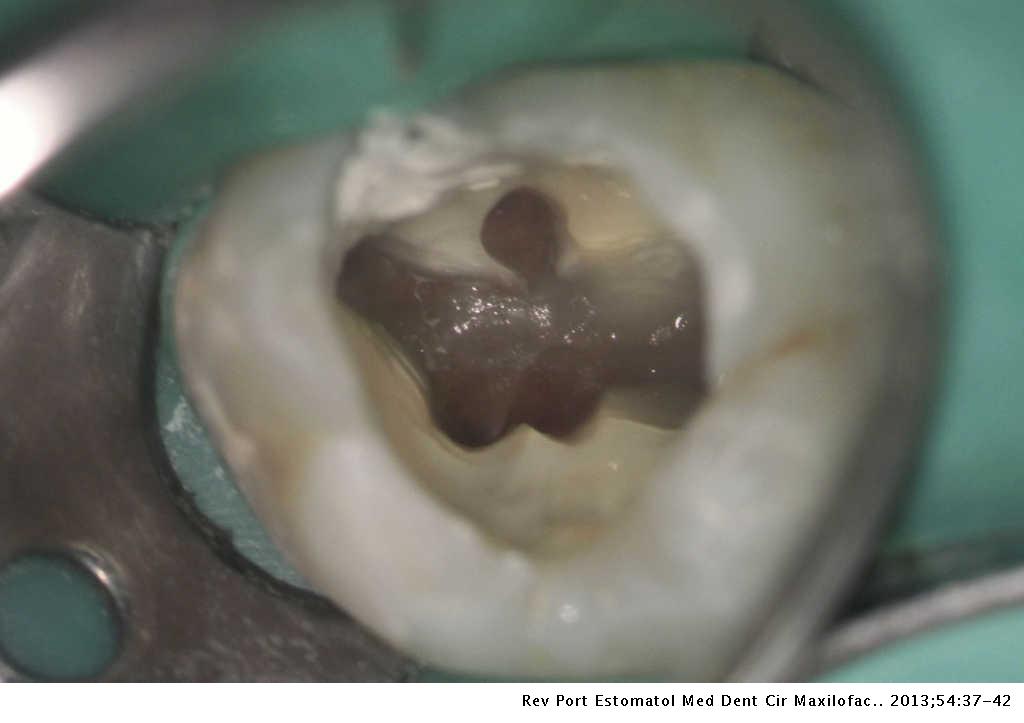 Endodontic Treatment Of The Maxillary First Molar With Five Root