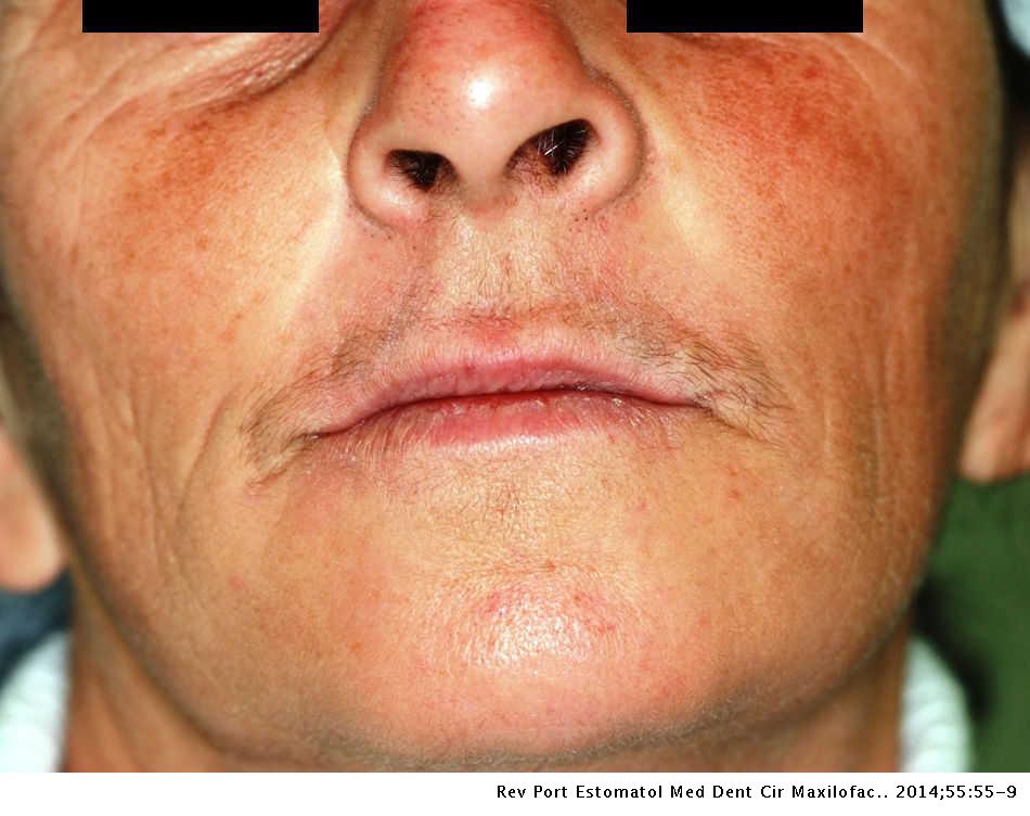 Nasolabial Cyst A Case Report Revista Portuguesa De Estomatologia Medicina Dentaria E Cirurgia Maxilofacial