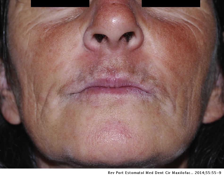 Nasolabial Cyst A Case Report Revista Portuguesa De Estomatologia Medicina Dentaria E Cirurgia Maxilofacial