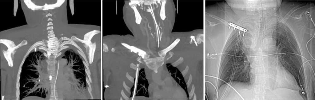 Hematoma Cervical E Hemotórax Espontâneos No Contexto De Neurofibromatose Tipo I Angiologia E 1057