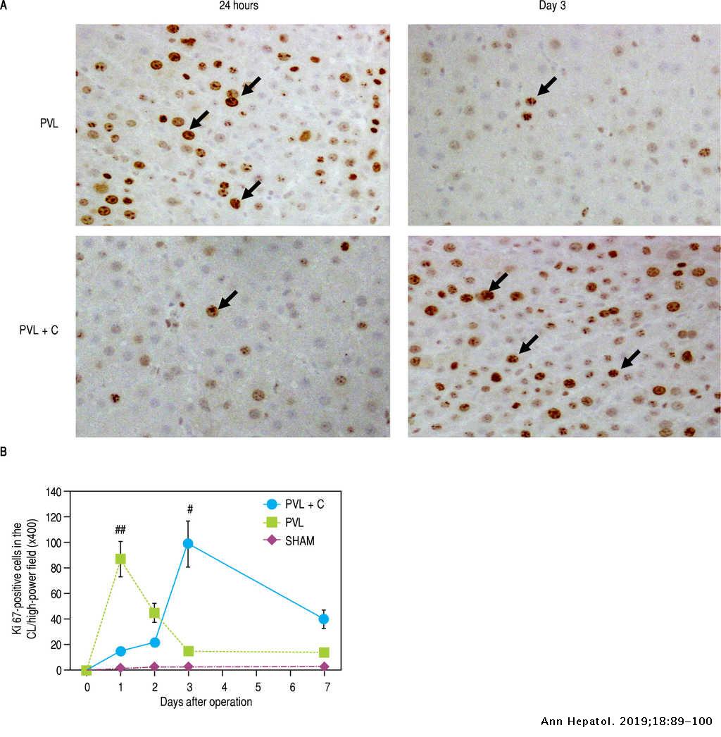 Effect Of Portal Vein Ligation Plus Venous Congestion On Liver Regeneration In Rats Annals Of Hepatology