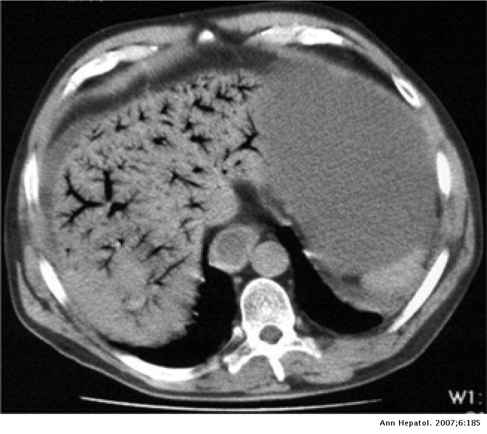 Hepatic portal venous gas Annals of Hepatology Hepatic portal venous gas Annals of Hepatology