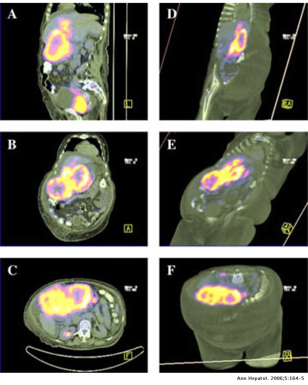 Fused PET/CT Images in Hepatocarcinoma | Annals of Hepatology