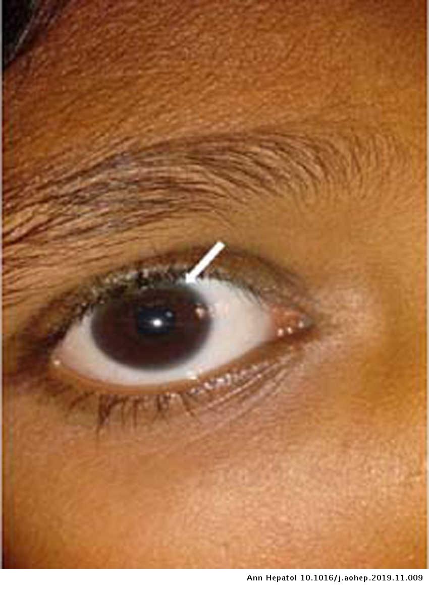 Ocular Manifestations Of Liver Disease In Children Clinical