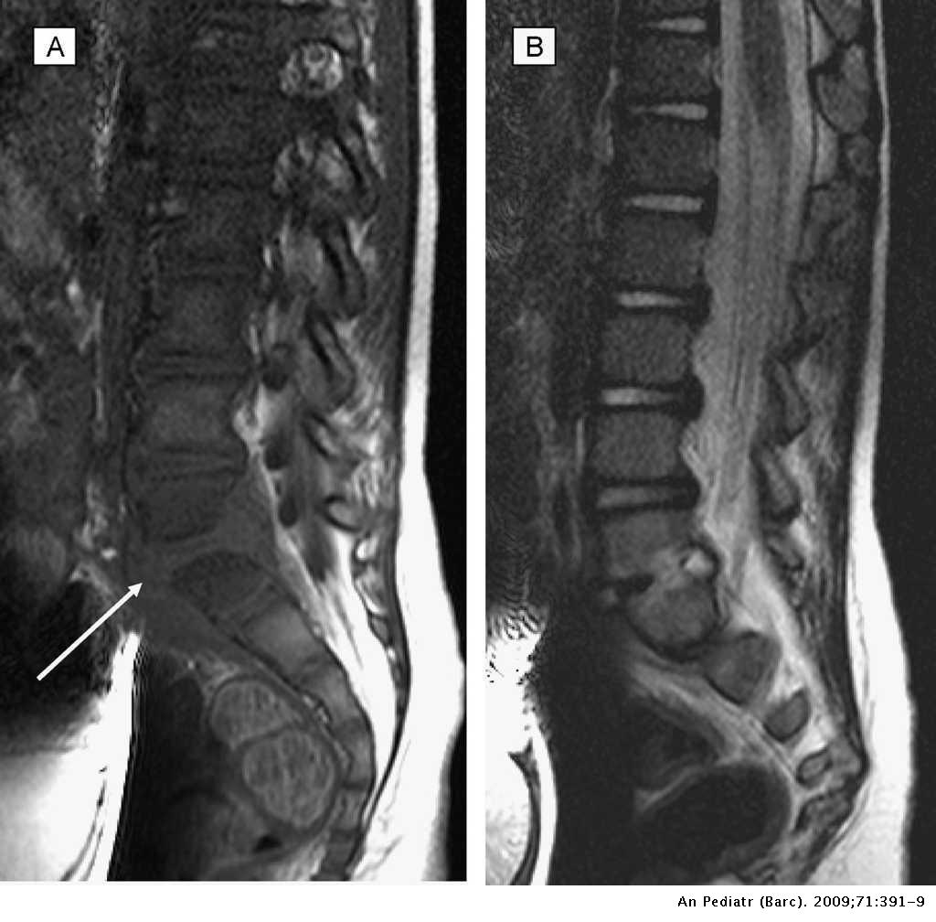 Espondilodiscitis diagnóstico y seguimiento a mediolargo plazo de 18 casos Anales de Pediatría Espondilodiscitis diagnóstico y seguimiento a mediolargo plazo de 18 casos Anales de Pediatría