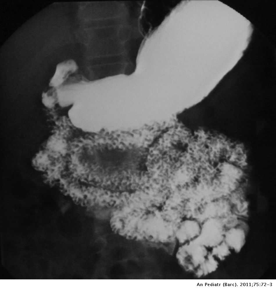 Dos observaciones de hiperplasia nodular linfoide intestinal asociadas a déficits inmunitarios | Anales de Pediatría Dos observaciones de hiperplasia nodular linfoide intestinal asociadas a déficits inmunitarios | Anales de Pediatría