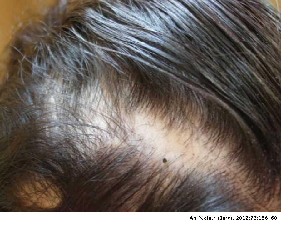alopecia hipertónia