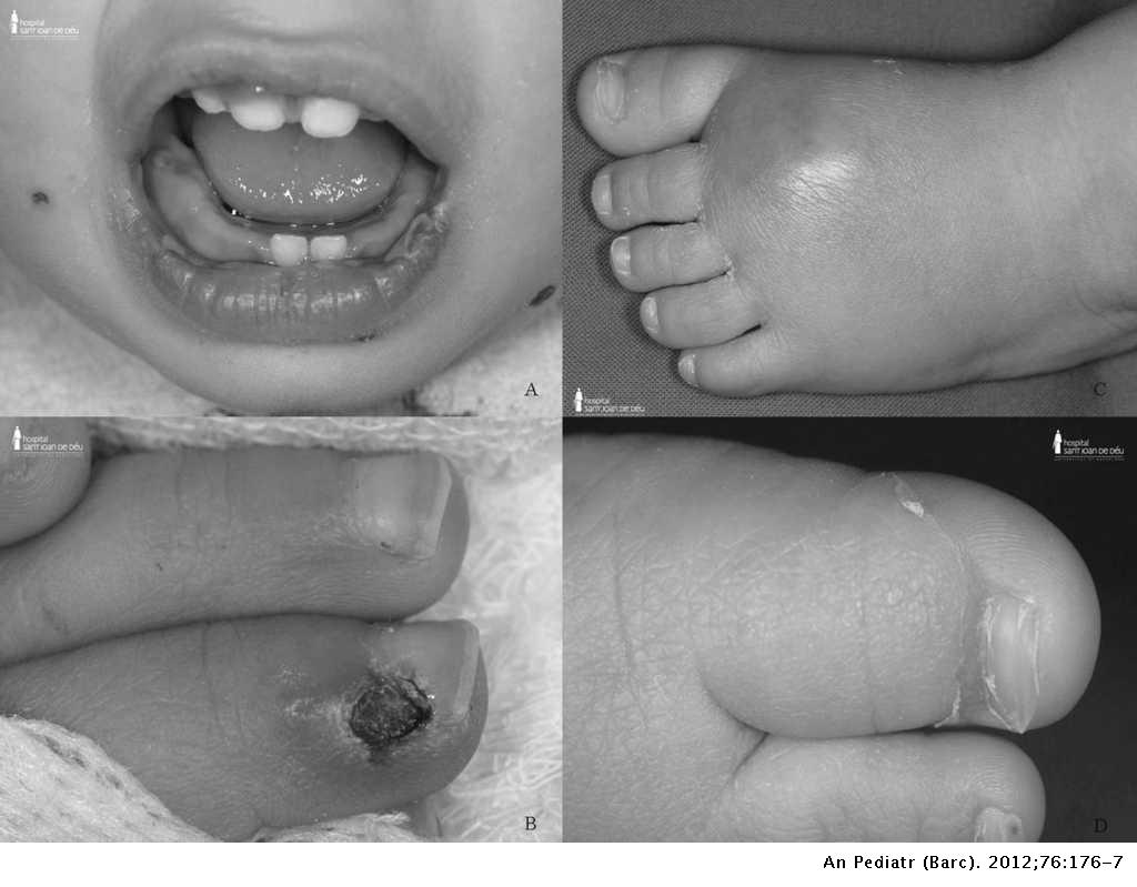 Infección estafilocócica diseminada con manifestaciones clínicas Kawasaki-like | Anales de Pediatría Infección estafilocócica diseminada con manifestaciones clínicas Kawasaki-like | Anales de Pediatría