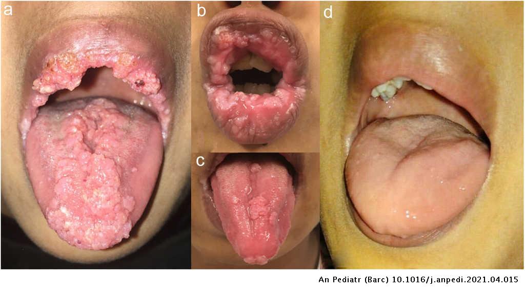 Hpv throat cancer blogs, Hpv throat cancer blog -, Papillomavirus humain comment s en debarrasser
