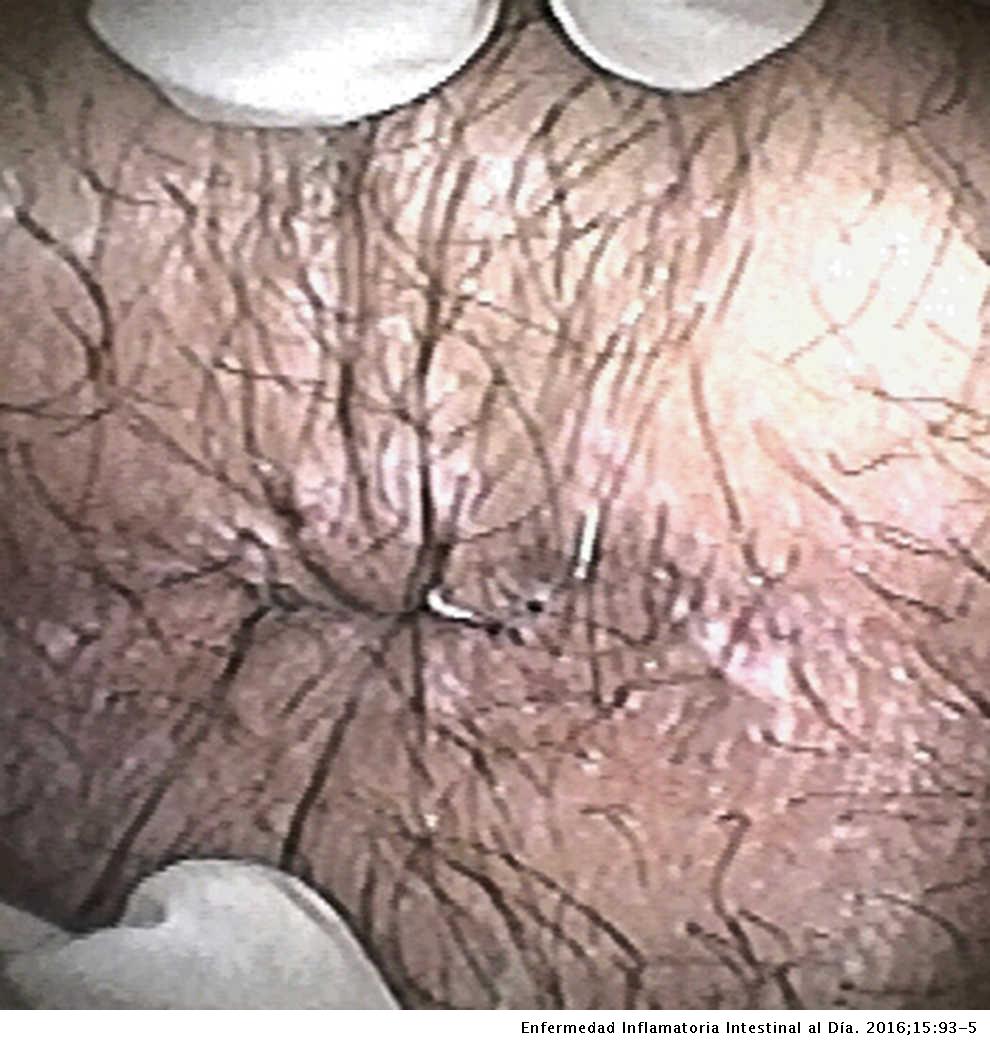 Hpv cause colon cancer. Hpv scc skin