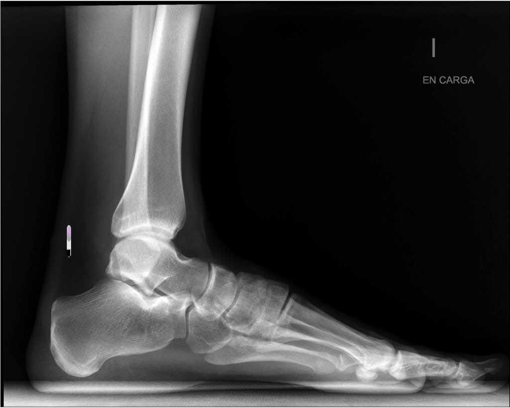 Osteoma Osteoide De Calcáneo Caso Clínico Y Revisión De La Literatura