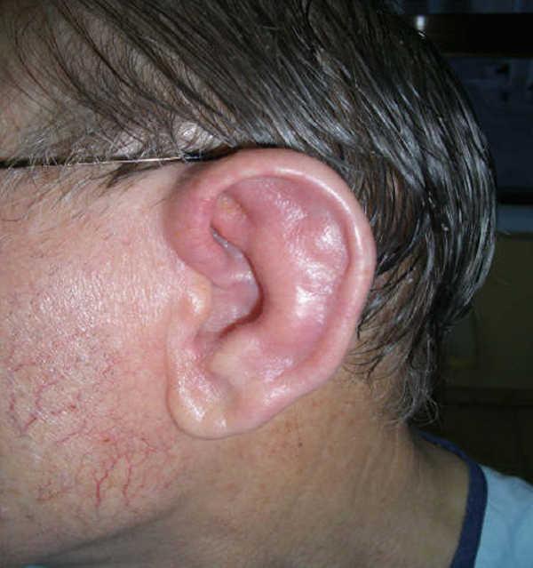 Que Es Celulitis Auricular