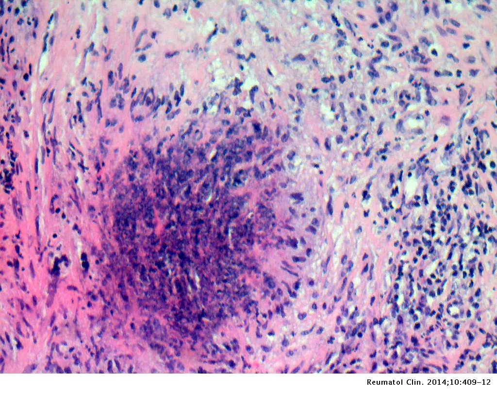 Colliculitis és prostatitis