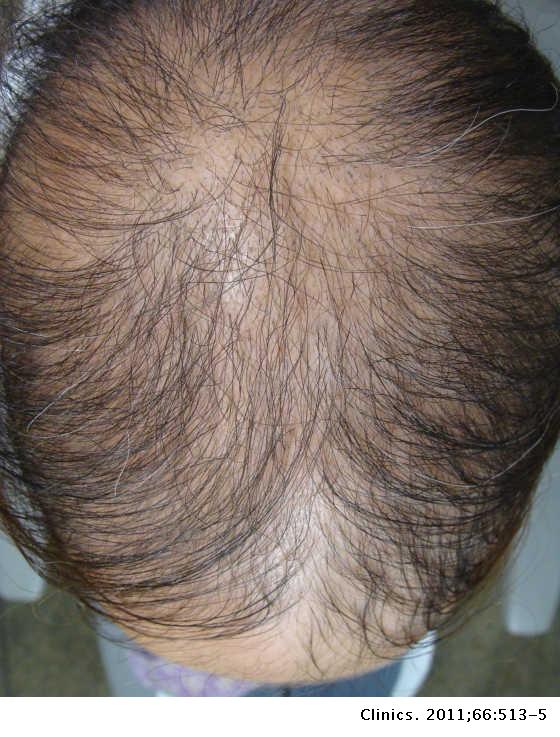 Alopecia areata incognita | Clinics Alopecia areata incognita | Clinics