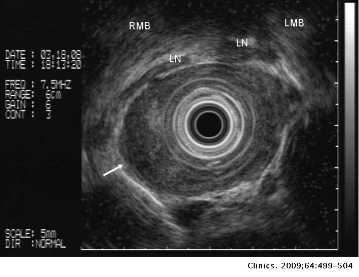Endobronchial Ultrasound Application for Diagnosis of Tracheobronchial ...