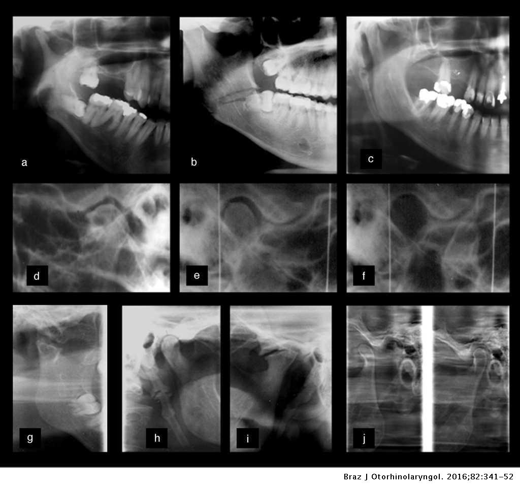 Diagnosis Of Temporomandibular Joint Disorders Indication Of Imaging Exams Brazilian Journal Of Otorhinolaryngology