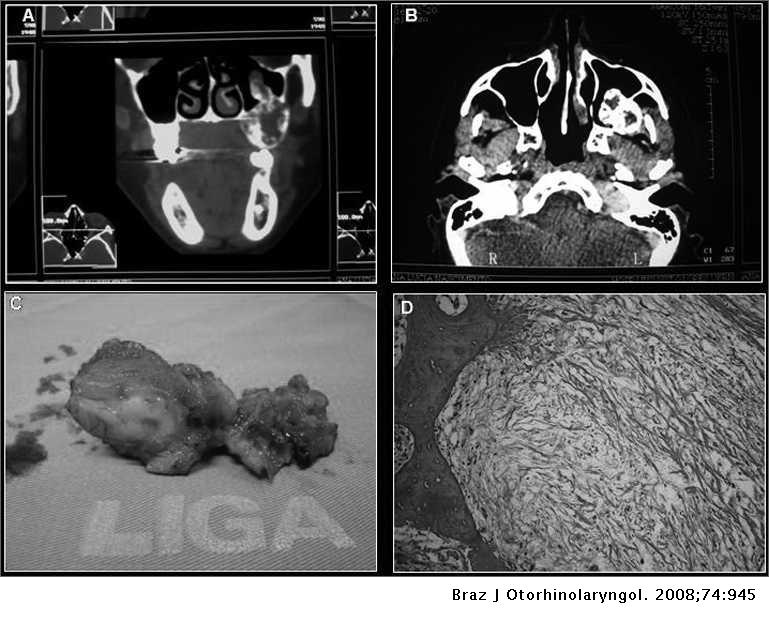Odontogenic Myxoma Of The Maxilla Invading The Maxillary Sinus Brazilian Journal Of Otorhinolaryngology Odontogenic Myxoma Of The Maxilla Invading The Maxillary Sinus Brazilian Journal Of Otorhinolaryngology