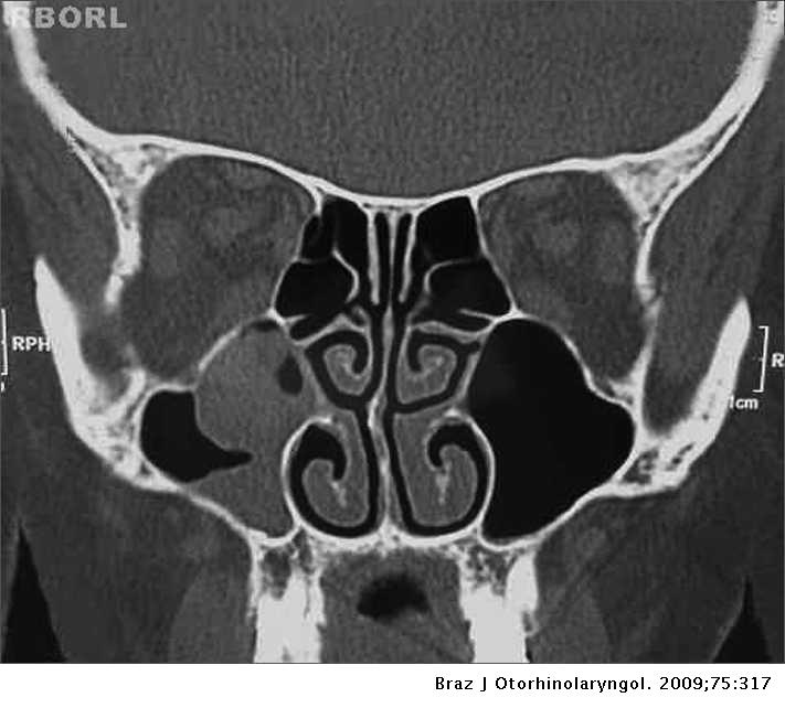 oncocytic papilloma nasal