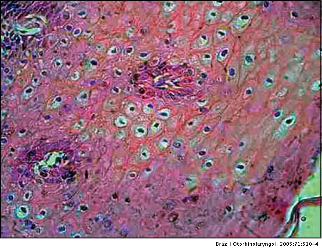 human papillomavirus cytopathic effect