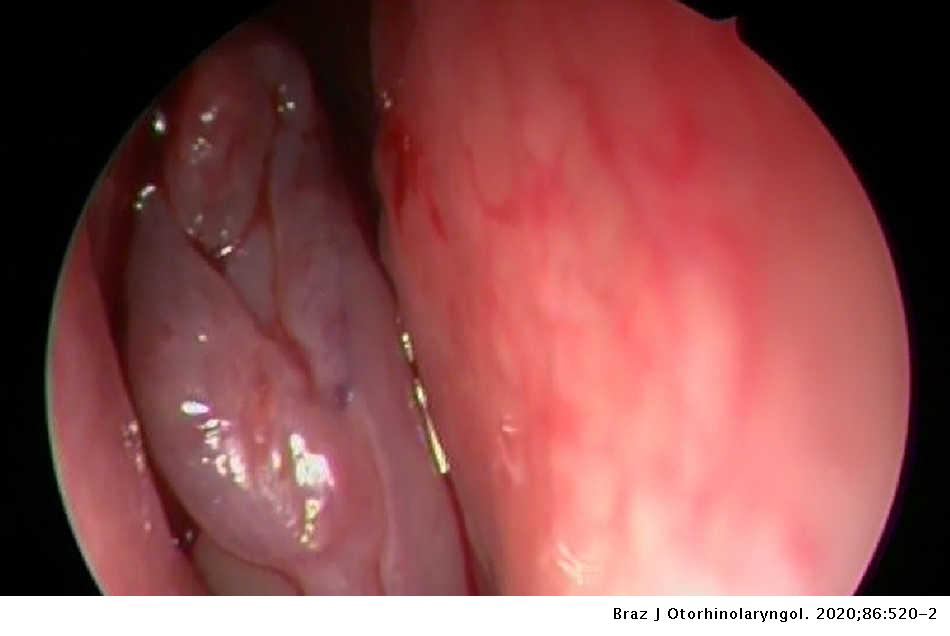sinonasal inverted papilloma tumor