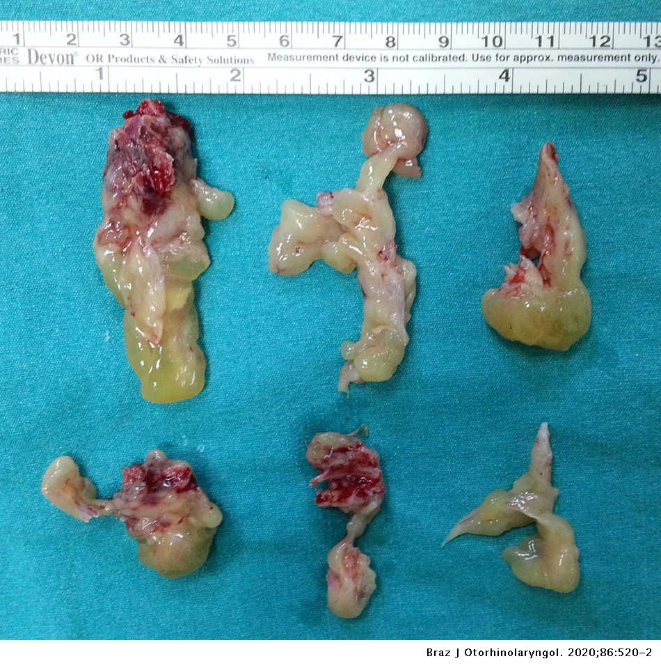 sinus papilloma symptoms