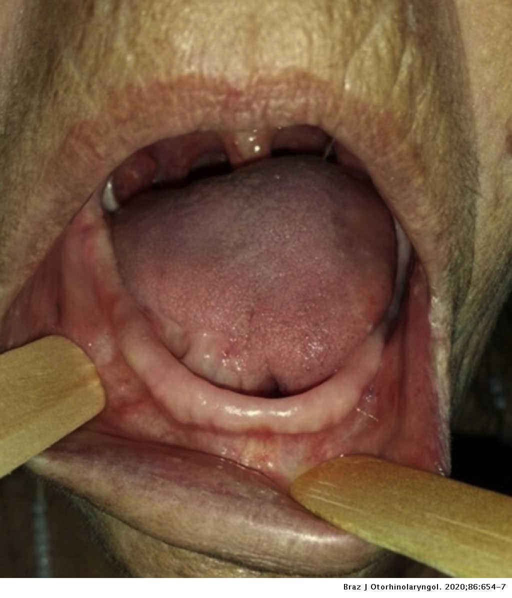 Squamous papilloma of mouth