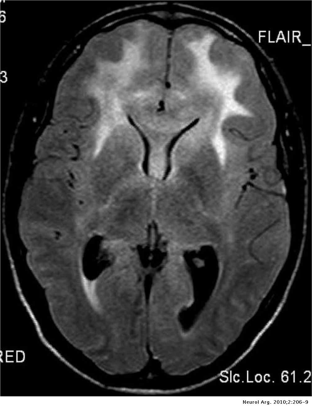 Gliomatosis cerebri Neurología Argentina