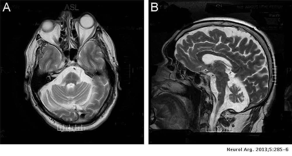 Krónikus prosztatitis az MRI- n