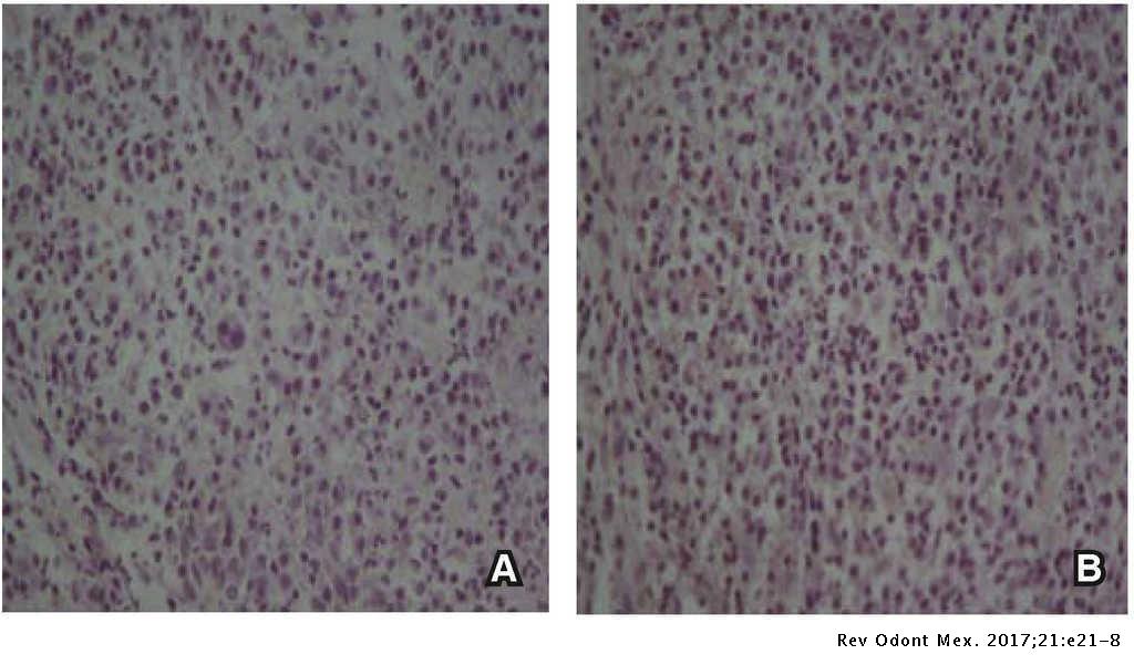 Correlation Of Clinical Radiographic And Histological Diagnoses Of Apical Dental Lesions Revista Odontologica Mexicana