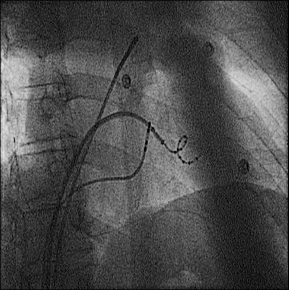 Entrapment of Circular Mapping Catheter in the Mitral Subvalvular