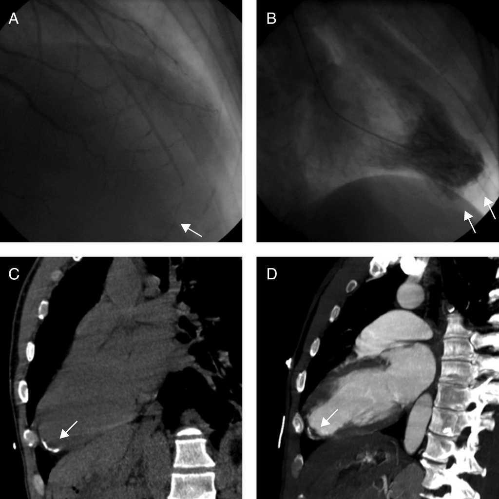 Apical Aneurysm in a Full-Contact Fighter | Revista Española de Cardiología