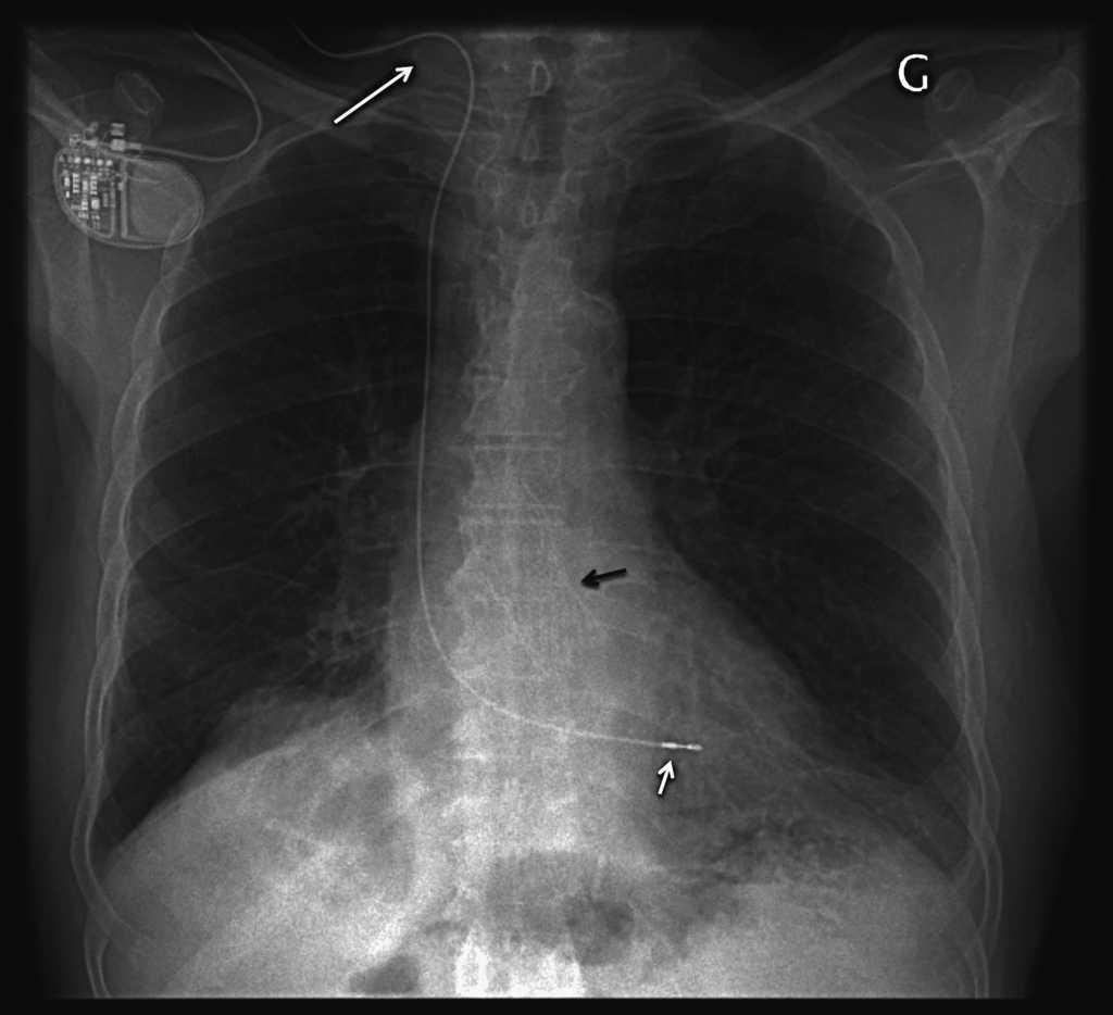 use-of-an-explanted-pacemaker-connected-to-a-regular-screw-in-lead-for