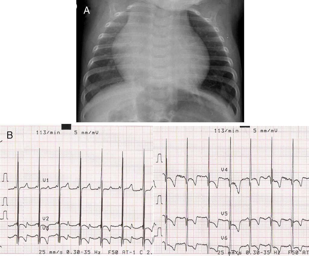 When Should We Start Enzyme Replacement Therapy For Infantile Pompe Disease With Severe Cardiomyopathy Revista Espanola De Cardiologia When Should We Start Enzyme Replacement Therapy For Infantile Pompe Disease With Severe Cardiomyopathy Revista Espanola De Cardiologia