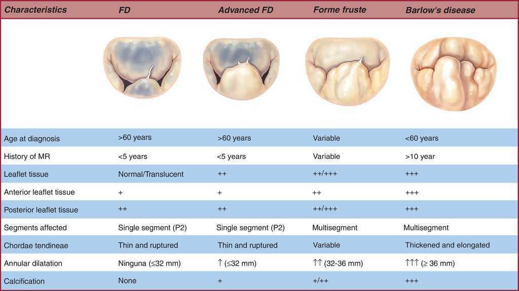 Normal Mitral Valve