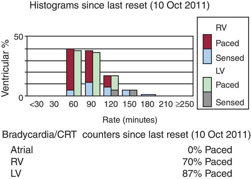 How To Assess The Nonresponder To Cardiac Resynchronization Therapy A Comprehensive Stepwise Approach Revista Espanola De Cardiologia