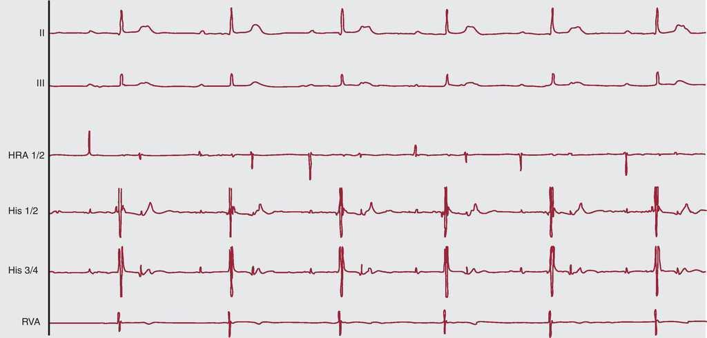 Bradyarrhythmias And Conduction Blocks Revista Espanola De Cardiologia Bradyarrhythmias And Conduction Blocks Revista Espanola De Cardiologia